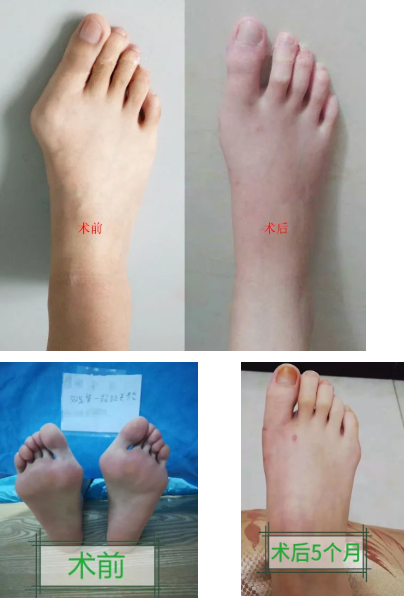 南京股骨髋拇外翻医院专科精微矫形矫形既快又好