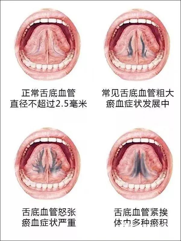 舌下络脉诊法在临床上的应用