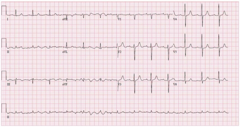 病例|心电图挑战:心脏移植术后,ecg提示心律失常,如何