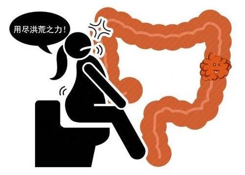 肠息肉"癌变",身体会有哪些症状?出现这3种迹象,千万别拖!