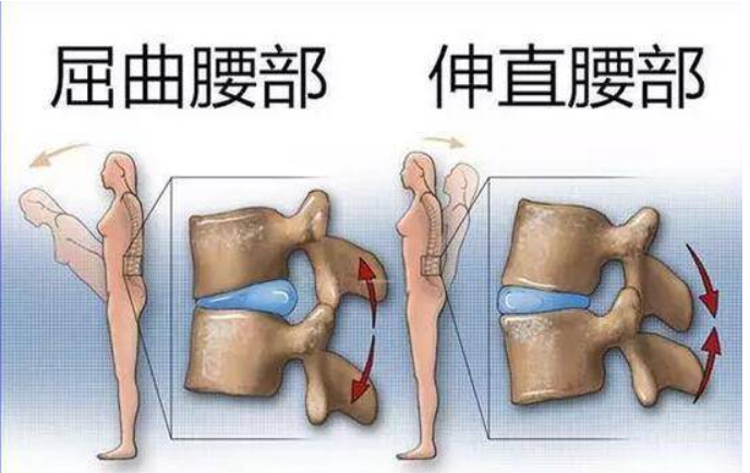 腰部疼痛难忍?这三种方法,可帮你早日告别腰椎间盘突出