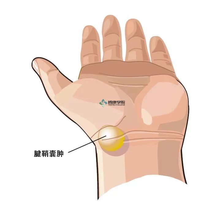 疼痛解剖学腕关节腱鞘囊肿掌屈背伸试验