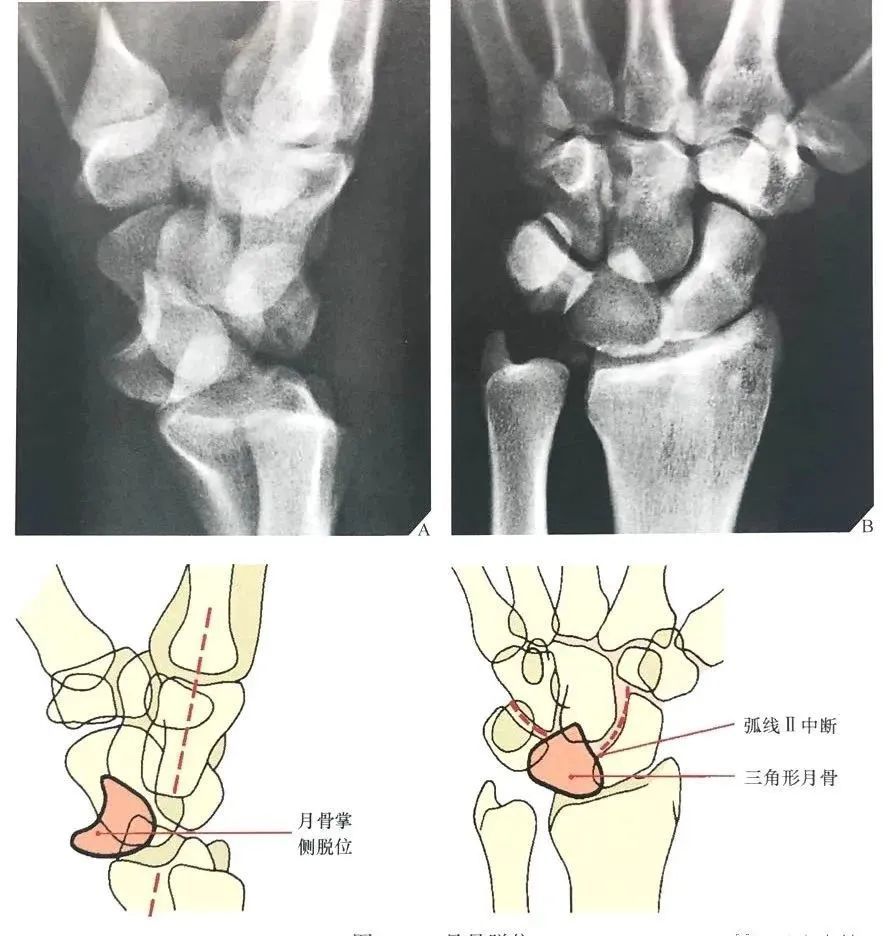 骨科精读腕关节x线解剖及诊断这份图谱太实用了