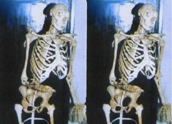 湖北野人"猴娃",死后9年法医开棺验尸,证实了35年前的