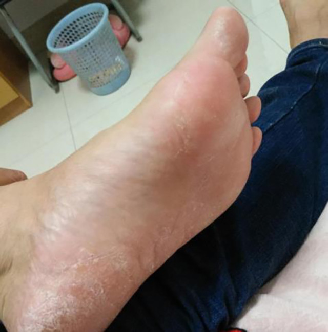男子脚气,又因闻臭袜子致肺部真菌感染