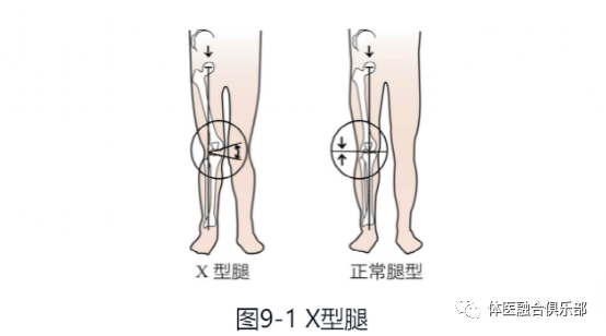 x/o型腿,扁平足该如何跑步?(一)