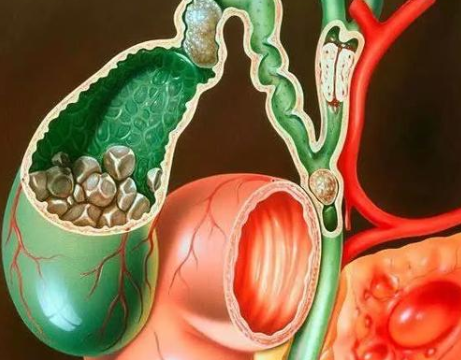 胆囊癌患者腹痛应尽早采用中医治疗以便于预后的改善