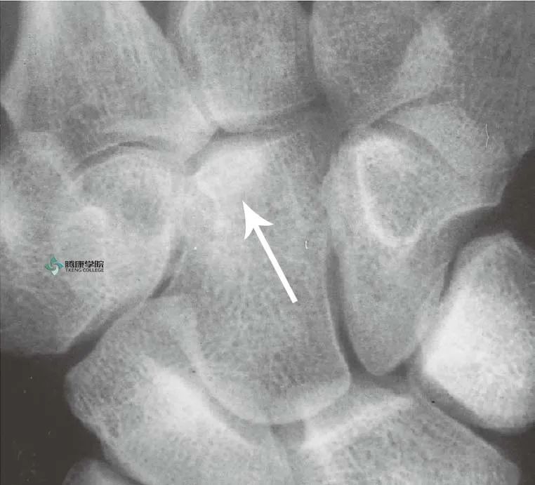腕部疣突也称为柱状骨,是用来描述发生于第或者第三腕掌关节背侧面的