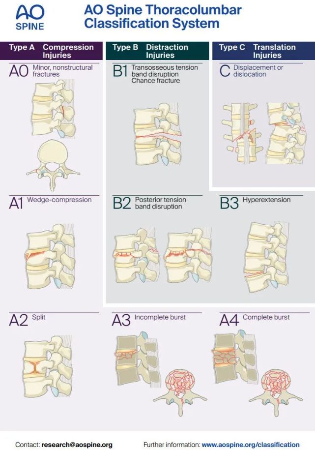 骨科精读|一文读懂胸腰椎骨折的ao分型与tlics,载荷