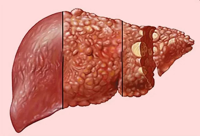 从酒精性脂肪肝到肝癌,需要几步?