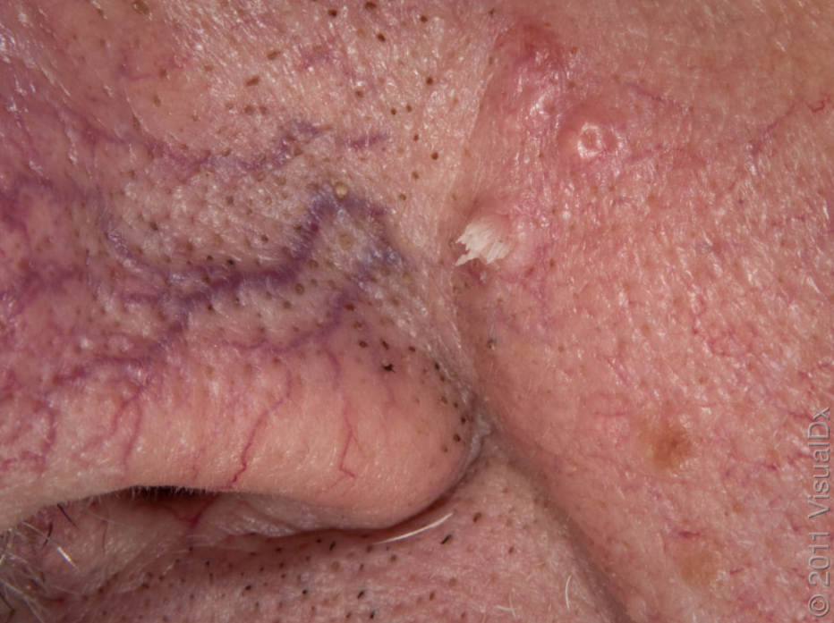 com/ 疾病介绍 丝状疣是 人乳头瘤病毒( hpv )感染皮肤后引起的局部