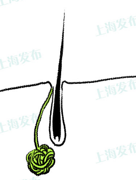 产生的原因 大汗腺由两部分组成:分泌部和导管.