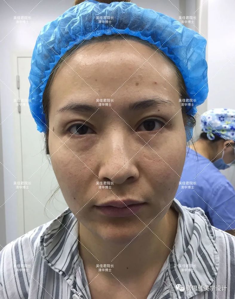 小拉皮术后7个月,她公开了全部手术细节!