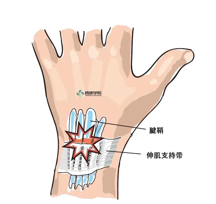 疼痛解剖学|腕伸肌腱鞘炎:tuck征