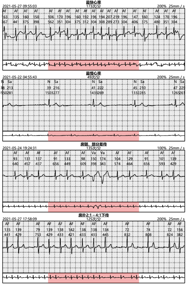 卡帕奇心电贴临床应用病例分享(三十五)|阵发房颤