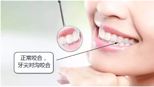 正常咬合:上排牙齿的窝,对下排牙齿的尖,上排牙齿在前,上排牙齿盖住
