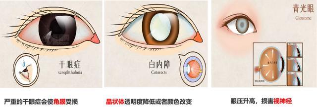 干眼症,白内障,青光眼……这些护眼小技能你get了吗?