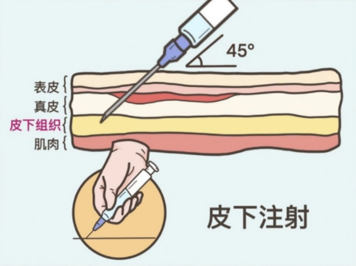 最不疼:肌肉注射 疼痛感