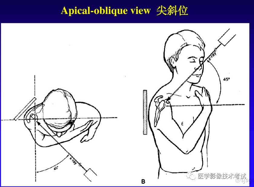 肩胛骨正位 3.腋位 1.肩胛骨正位(同上 2.西点位 1.肩关节正位 3.
