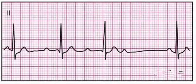 14种常见心电图波形的特点,建议收藏!