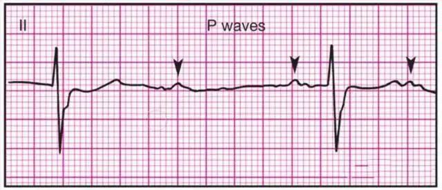 村医福利:14种常见心电图波形鉴别,病症解读,建议收藏