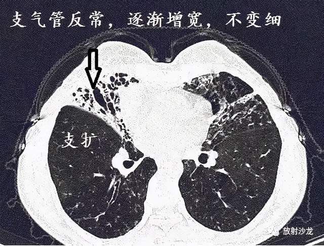 经典图谱,详细解说支气管扩张ct小诀窍_腾讯新闻