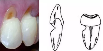 牙本质暴露|牙齿|楔状缺损
