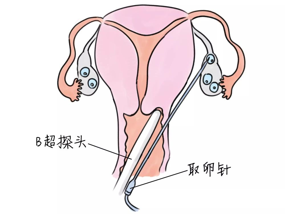 试管婴儿取卵术后,如何让卵巢更快恢复?