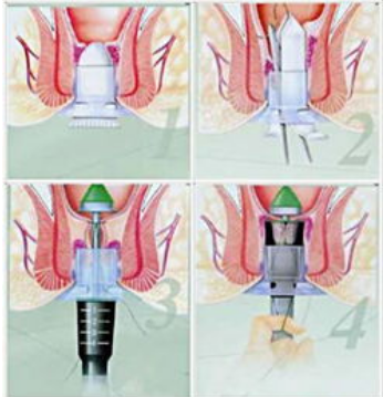 (3)内痔套扎治疗(rph)使用器械将小型胶圈套入内痔的根部,阻断内痔的