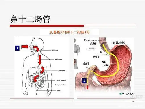【业务动态】普定县人民医院icu开展鼻肠管盲插置入术