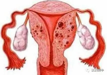 引起子宫内膜息肉原因有哪些如何确认长息肉了会有什么后果呢
