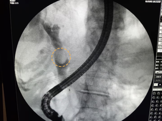 百岁奶奶过六一,专家玩转ercp!仅用30min解决半年的结石腹痛困扰