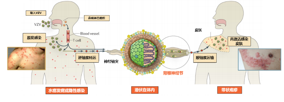 【北京疾控提醒您】水痘和带状疱疹的关系,你了解多少