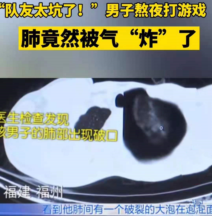 因队友太坑,男子把肺"气炸了",究竟发生了什么?