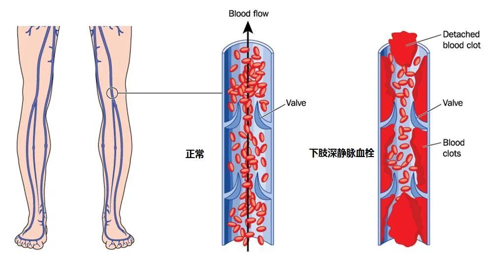 【关注】深静脉血栓的预防