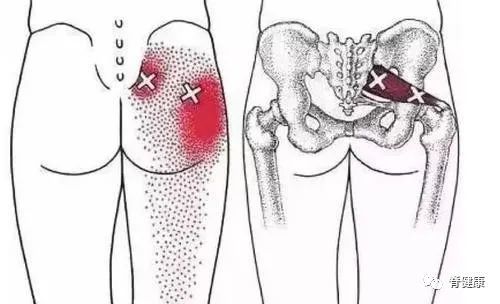 有时会合并麻木感,疼痛部位多涉及腰部,臀部,大腿后侧,小腿后外侧和足