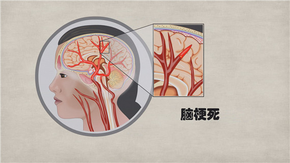脑梗患者需要注意什么?不能吃什么?