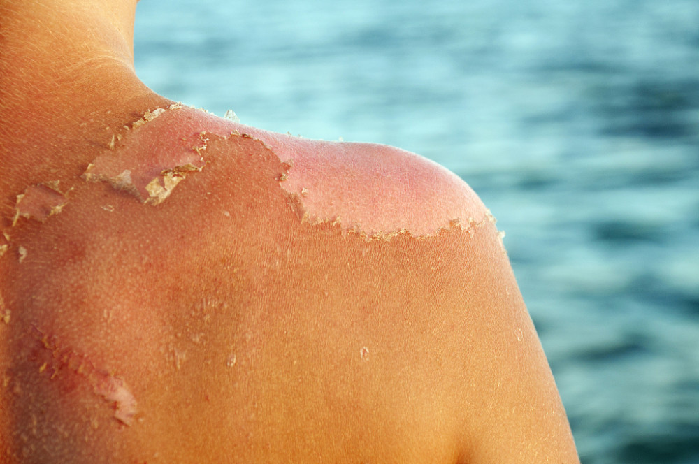 皮肤晒伤到底该如何修复?几个方法可帮你轻松改善