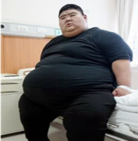 中国第一胖王浩楠:一年减掉363斤,变瘦后抱得美人归