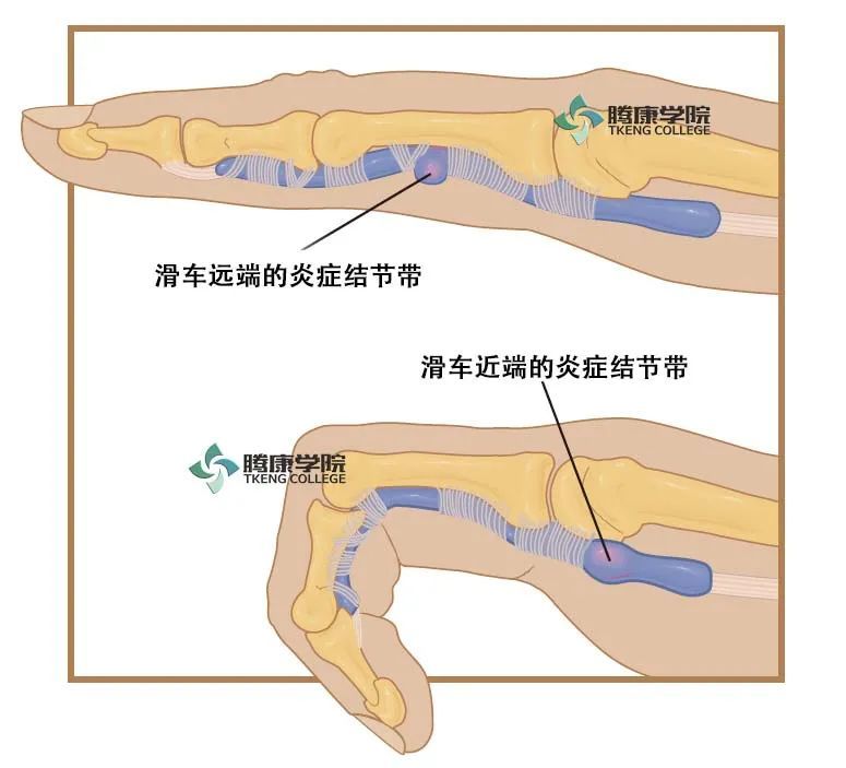 疼痛解剖学|扳机指综合征:弹响征