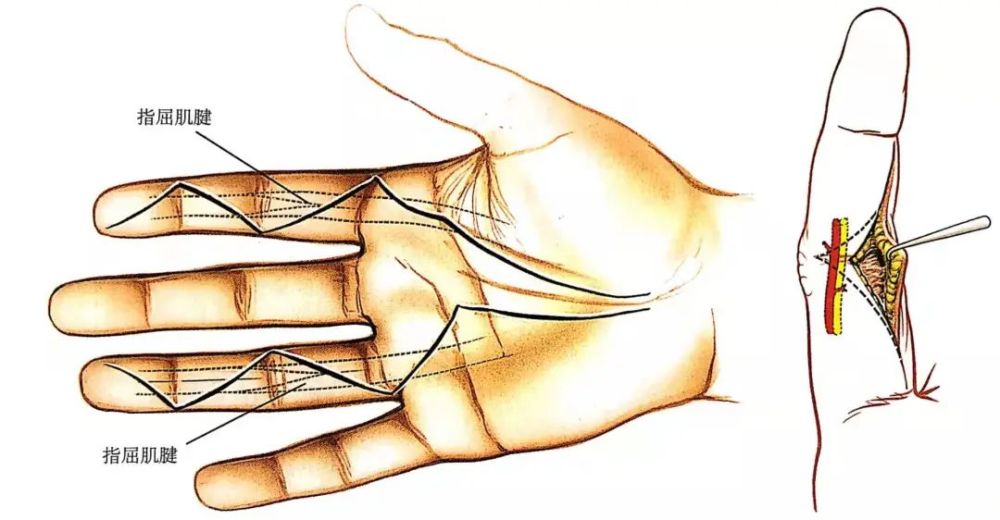 【骨科小技巧】腕关节掌侧入路如何扩大切口?