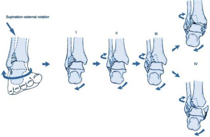 踝关节骨折的lauge-hansen分型