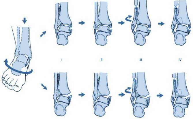 足处于旋前位,距骨受到外旋应力,以外侧为轴向前外方旋转,踝关节内侧