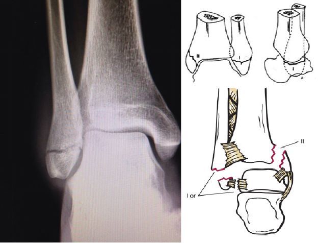 (1)内踝骨折线基本垂直于踝关节 (2)腓骨骨折位于下胫腓联合水平以下