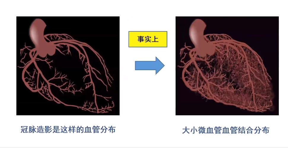 钱菊英教授:冠状动脉微血管病变的现状与挑战