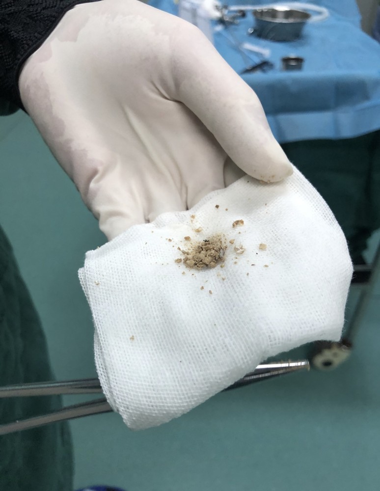 肾结晶是怎么回事 腾讯网
