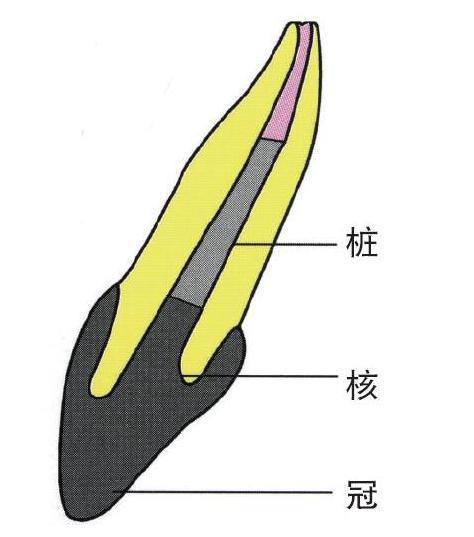 深圳根管治疗科普什么情况需要进行桩核冠修复呢修复时机是什么时候呢