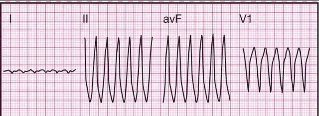 14种常见心电图波形的特点,建议收藏!