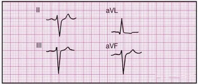 14种常见心电图波形的特点,建议收藏!