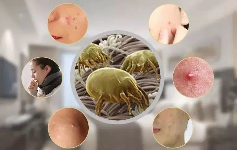 螨虫:螨虫叮咬人后皮损为圆形红色斑疹,丘疹或丘胞疹,少数会有大小不
